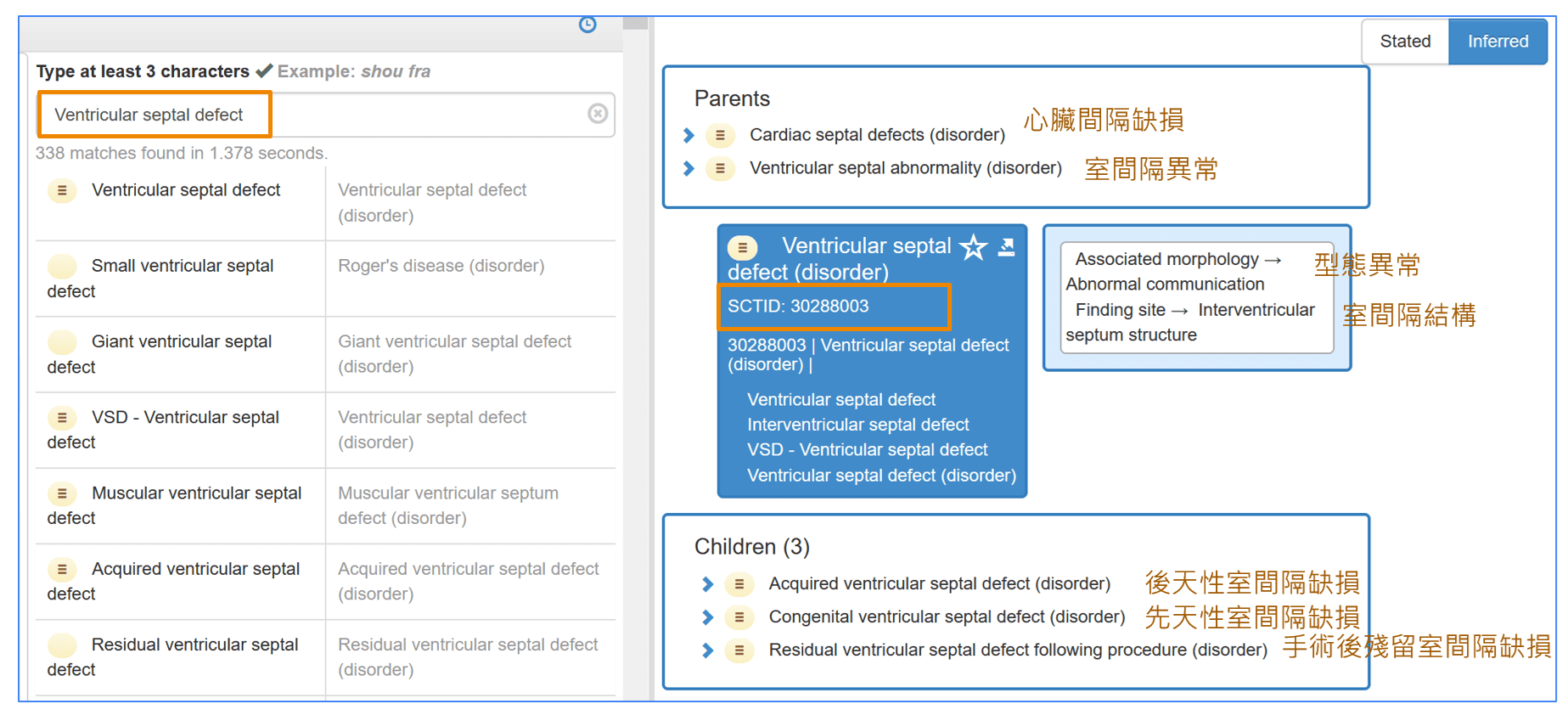 ventriculay-septal-defect-(summry)